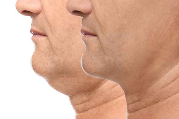HIFU - Breakthrough in Anti - ageing 2 hifu results Eastbourne
