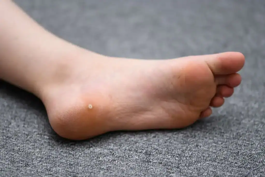 Cryotherapy For Warts And Also Verrucas 2 Image of verruca on the bottom of the foot that able to be treated with Cryotherapy Eastbourne