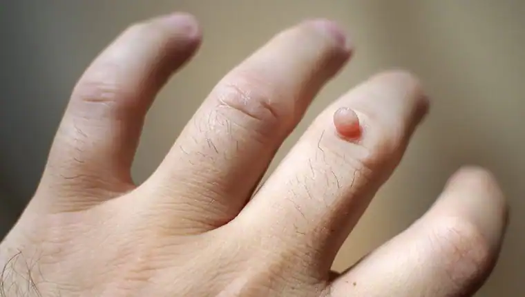 Image of blemish that Cryotherapy Eastbourne can remove with Lipo 360.