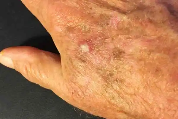 Image of Actinic keratoses Eastbourne on a person hand