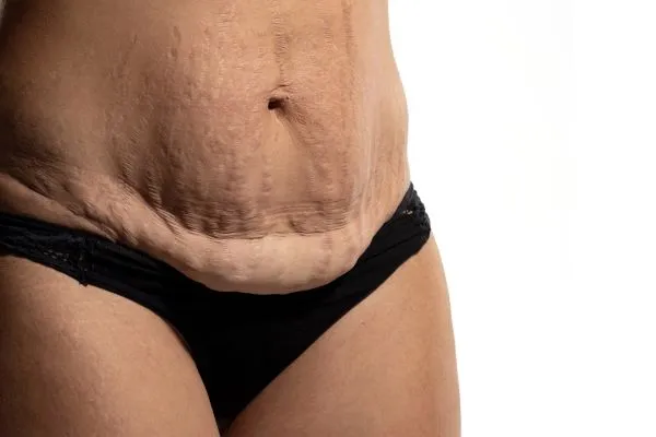 The Science of Skin Tightening 1 The science behind skin tightening Eastbourne picture of a woman's sagging skin on the stomach